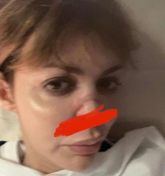 Алиса Аршавина показала, как выглядела в больнице после перенесенной операции
