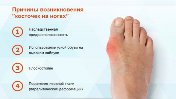 BКосточка на ноге как она образуется и как от нее избавиться